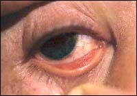 diphtheria conjunctivitis