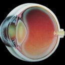 what causes cataracts