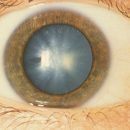 cataracts modern methods of treatment