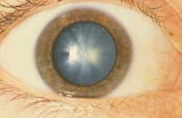 cataracts modern methods of treatment