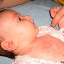 rashes on the body of a child