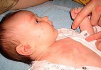 rashes on the body of a child