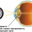 Cataract is there life after cataract