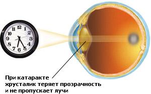 Cataract is there life after cataract