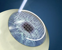 Méthode moderne de correction de la vision de Excimer-laser et de NDash; Femo-Lasik est maintenant disponible dans une clinique ophtalmique et laquo; excimer & raquo;