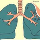 pulmonary atelectasis causes symptoms treatments