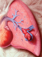Infarto polmonare: cause, diagnosi, trattamento