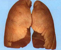 What is a lung gangrene
