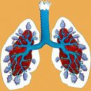 treatment of emphysema