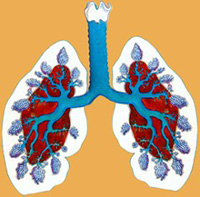Treatment of emphysema