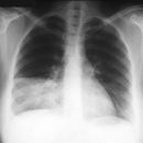pneumonia, inflammation of the lungs