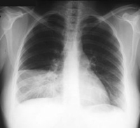pneumonia, inflammation of the lungs