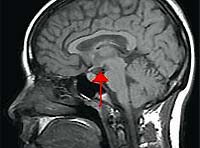 Ursachen, Entwicklungsmechanismus und Manifestation des Hypothalamus-Syndroms