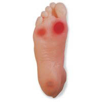 basic forms and signs of diabetic foot