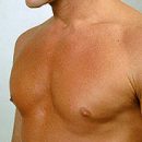 increase in mammary glands in males