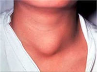Rilevazione anticipata del cancro della tiroide