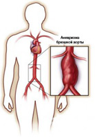the main manifestations and treatments for abdominal aortic aneurysm