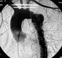 De viktigste symptomene og metodene for behandling av den thoracic aortas aneurisme