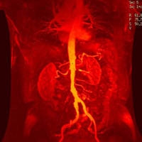 Magnetische resonantie angiografie met aneurysma