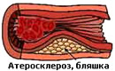 atherosclerosis of the lower extremities