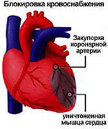 Ateroskleroza koronarne arterije srca
