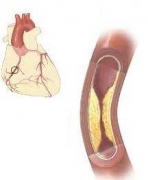 Sirds koronāro artēriju ateroskleroze