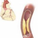 what we know about atherosclerosis