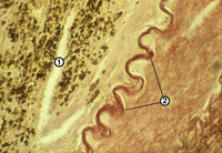 Atherosclerosis Aorta