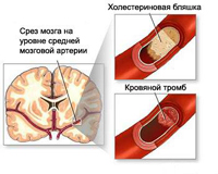 cerebral atherosclerosis