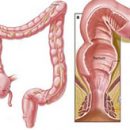 the main symptoms of fistula rectum