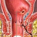 complications of Crohn's disease and their treatment