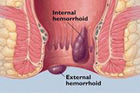 how to live without hemorrhoids