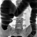 methods of instrumental diagnosis of Crohn's disease