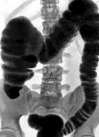 Методи за инструментална диагностика на болестта на Crohn