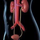 What is hydronephrosis