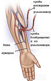 Dialýza je život