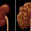 abnormalities of kidney structure