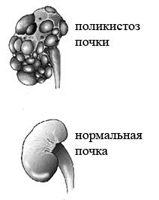 Anomalier av njurens struktur
