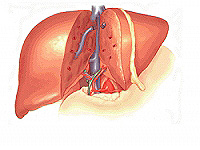 cirrhosis of the liver causes of the disease and treatment