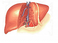 Cirrosis del hígado, causas de enfermedad y tratamiento