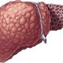 What is cirrhosis of the liver