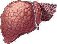 What is cirrhosis of the liver