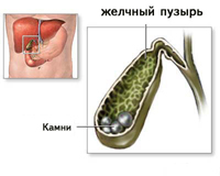 Chronická cholecystitida a onemocnění žlučových kamenů u těhotných žen