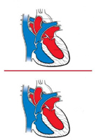 Stenoza aortnog ventila