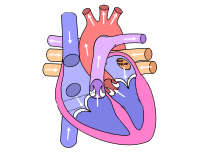 Manque de valve aortique
