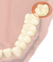 Инфекциозен ендокардит в стоматологията