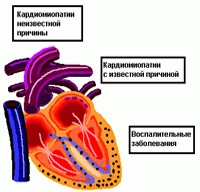 Cardiomiopatie restrictivă