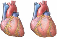 Sintomi della cardiomiopatia alcolica
