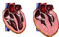 Orsaker till dilatation Kardiomyopati