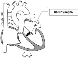 Defeitos cardíacos congênitos: estenose aórtica, aórtica grossa